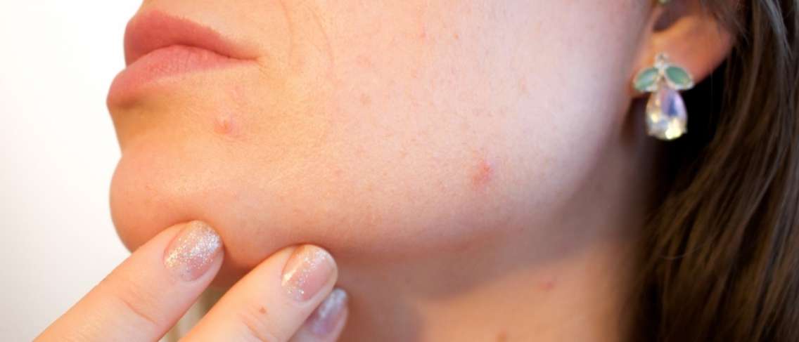 Connaître les types d'acné et comment les traiter