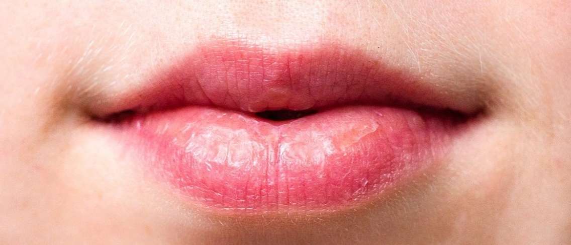 Причини сухості в роті під час пробудження і як її подолати