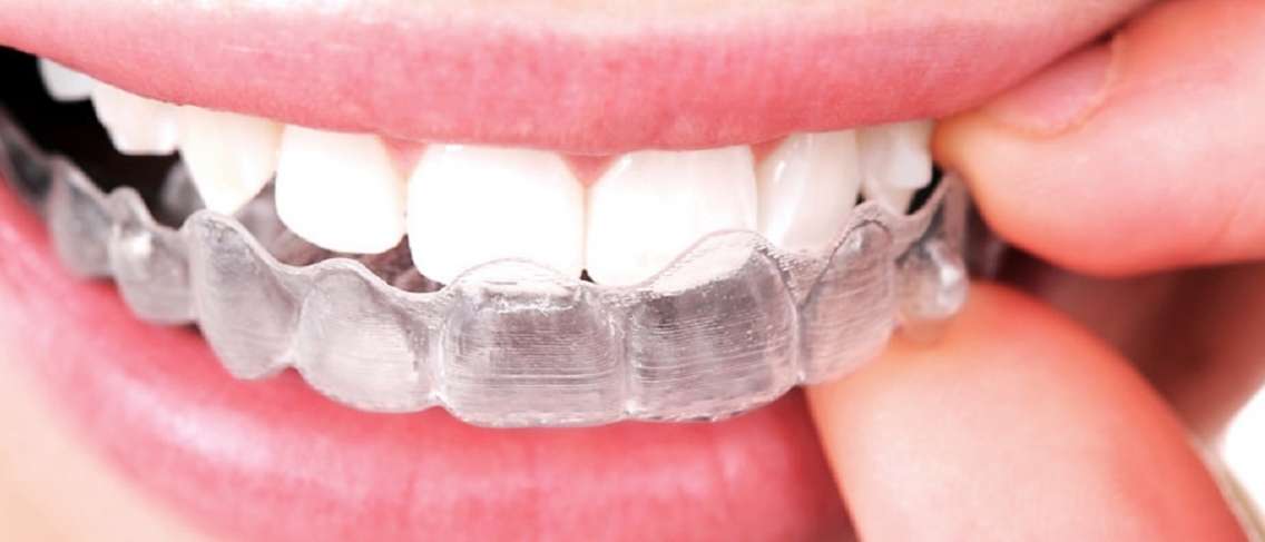 치아 교정을 위한 Invisalign의 플러스 마이너스