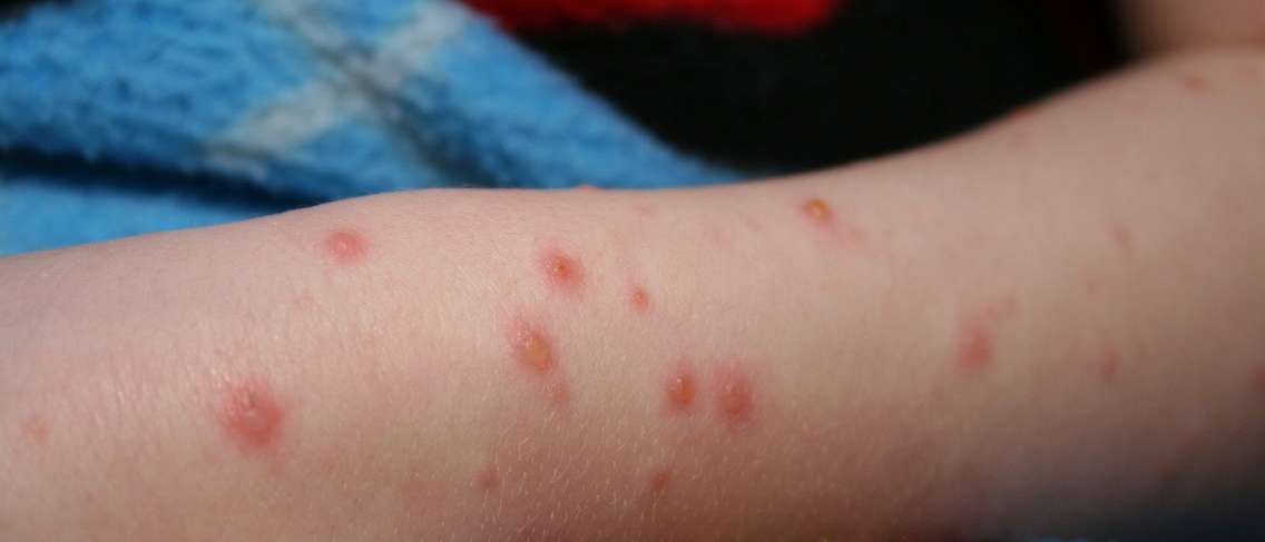Mythe ou réalité, quand la varicelle ne peut pas prendre de bain ?