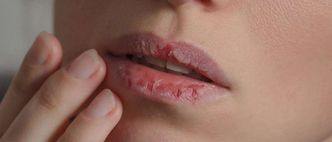 Oorzaken van schrale lippen, echt gebrek aan vitamines?