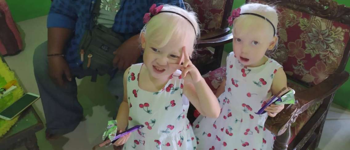 Increíbles gemelos albinos de Wonogiri, ¿qué causa albino?