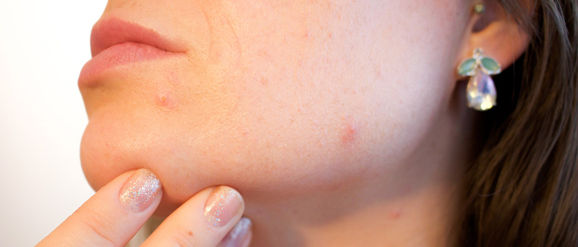 Masturbatie veroorzaakt acne op het gezicht?