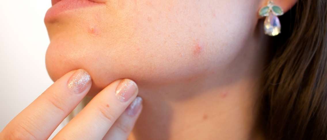 Voici comment vaincre l'acné pendant la grossesse !